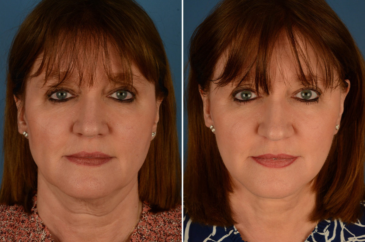 The UpLift™ Lower Face and Neck Lift Before and After Photos in Naples, FL, Patient 22892