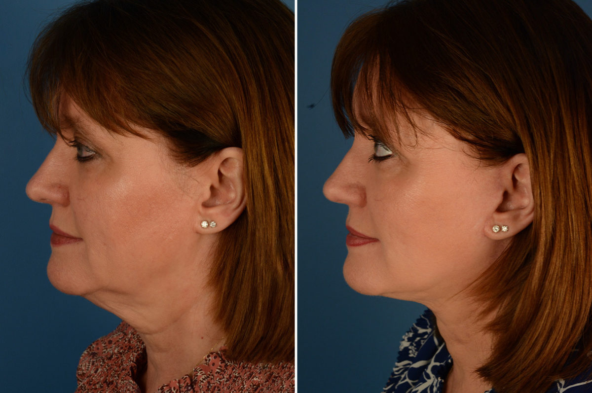 The UpLift™ Lower Face and Neck Lift Before and After Photos in Naples, FL, Patient 22892