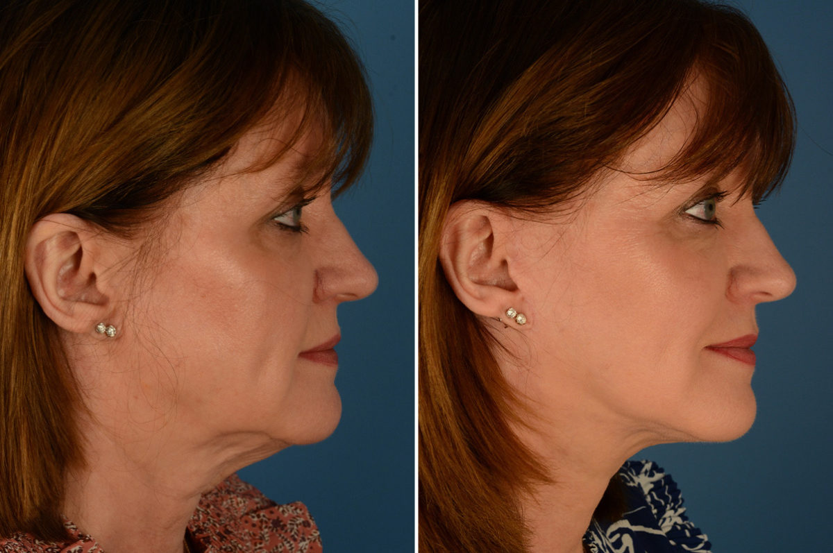 The UpLift™ Lower Face and Neck Lift Before and After Photos in Naples, FL, Patient 22892