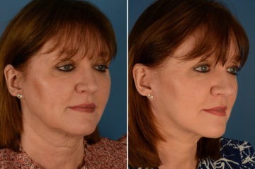 The UpLift™ Lower Face and Neck Lift Before and After Photos in Naples, FL, Patient 22892