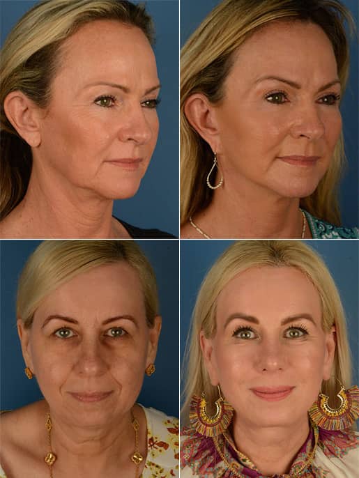 Facelift Procedure in Naples, FL