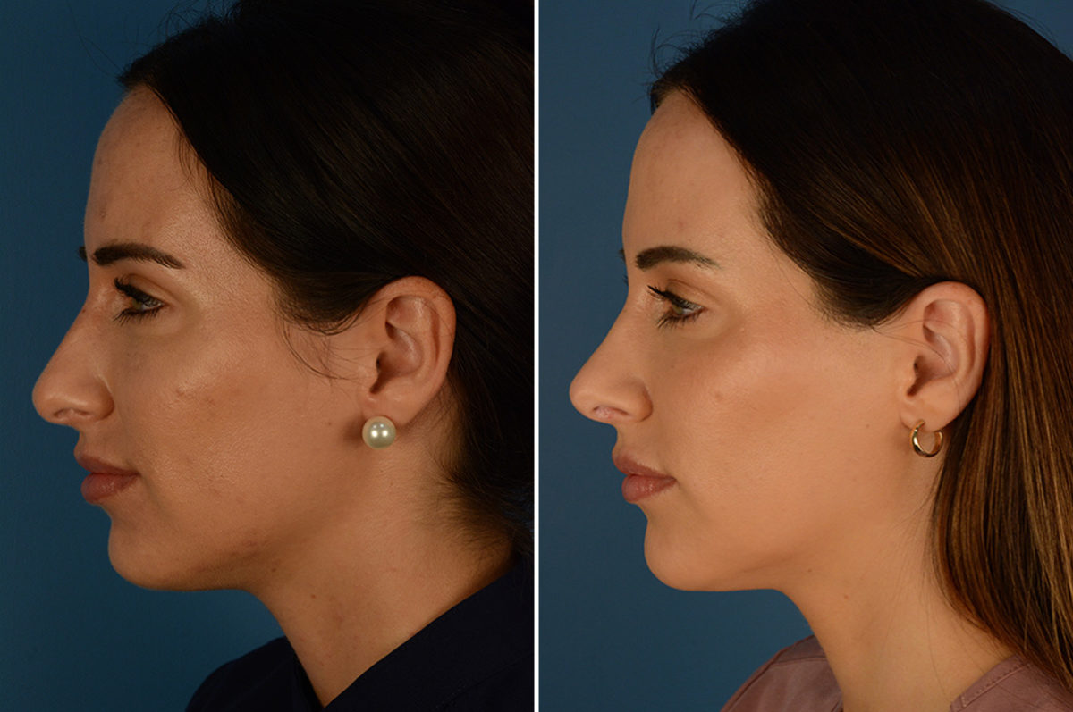 Rhinoplasty Before and After Photos in Naples, FL, Patient 23018