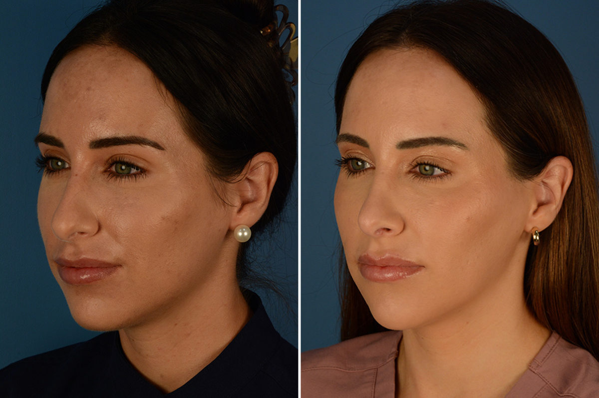 Rhinoplasty Before and After Photos in Naples, FL, Patient 23018