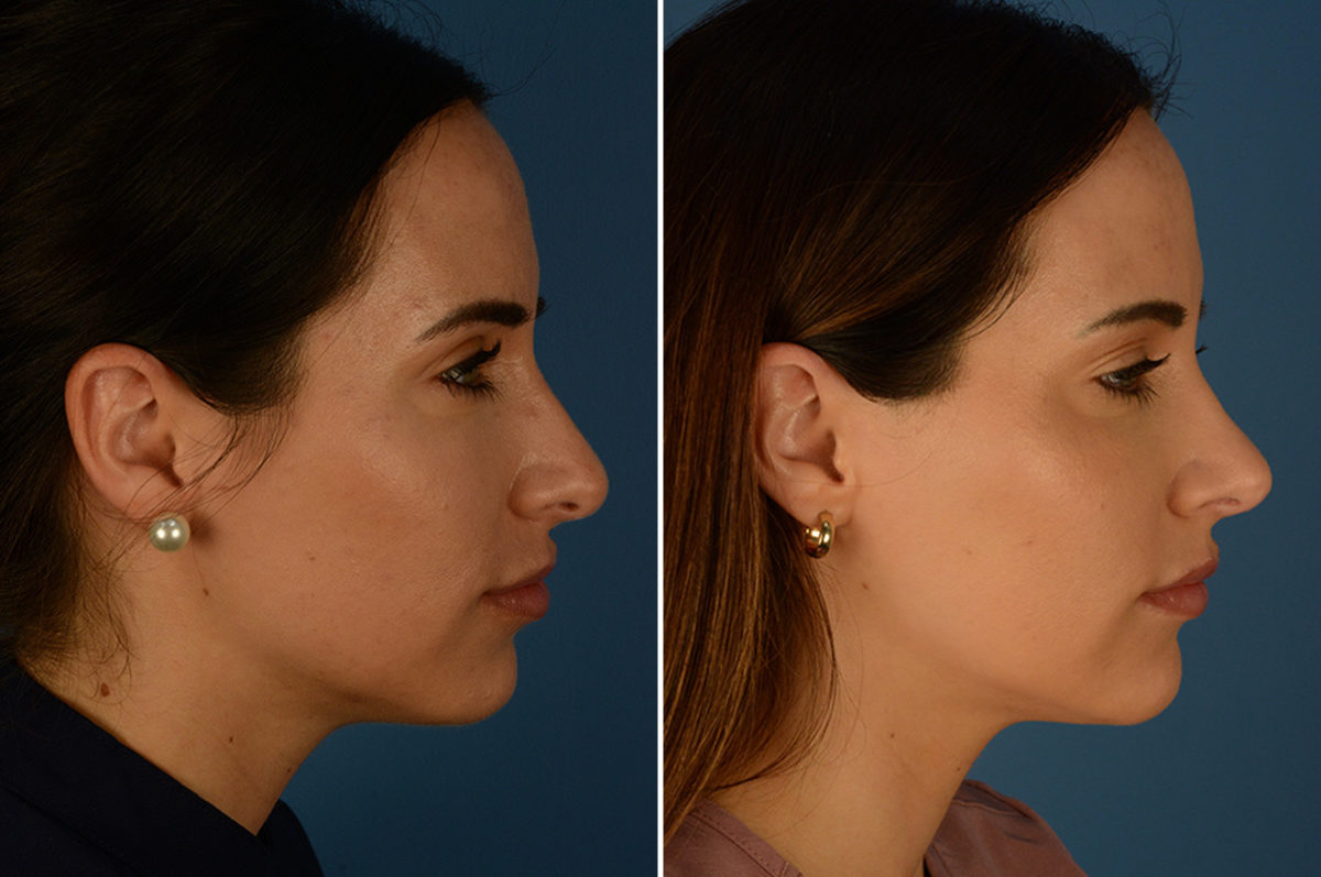 Rhinoplasty Before and After Photos in Naples, FL, Patient 23018