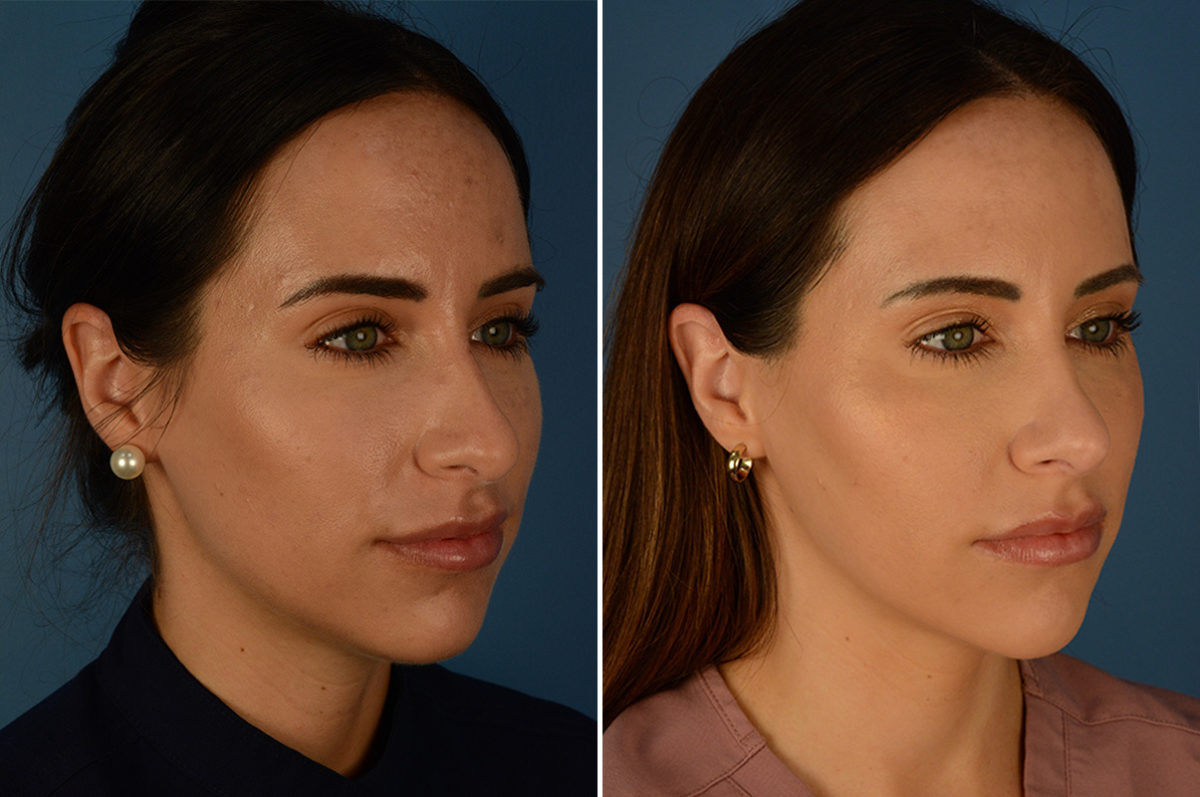 Rhinoplasty Before and After Photos in Naples, FL, Patient 23018