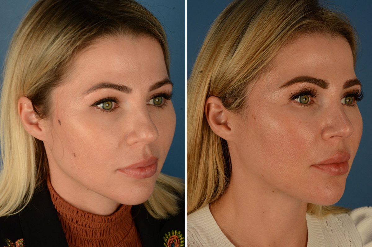 Rhinoplasty Before and After Photos in Naples, FL, Patient 23034
