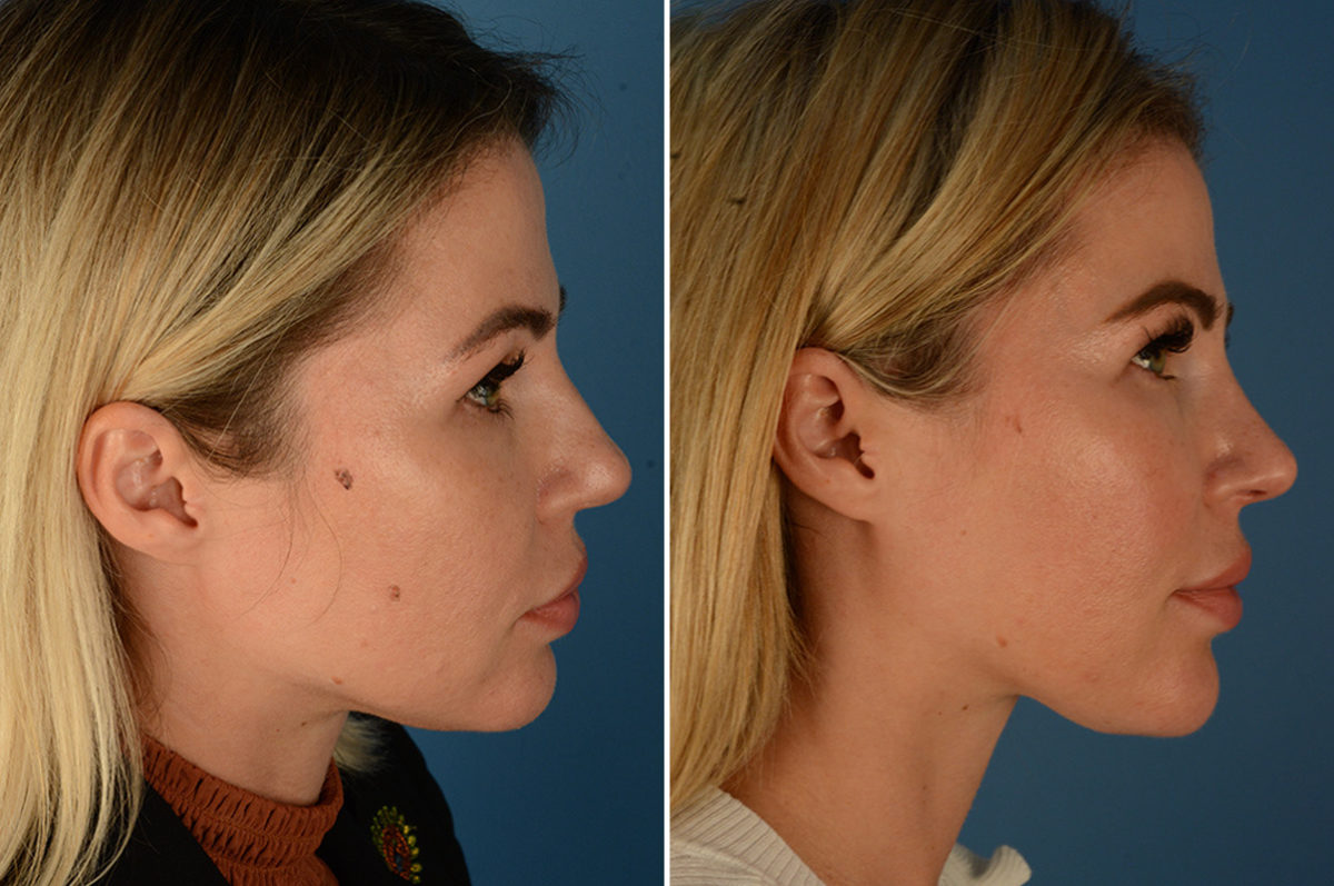 Rhinoplasty Before and After Photos in Naples, FL, Patient 23034