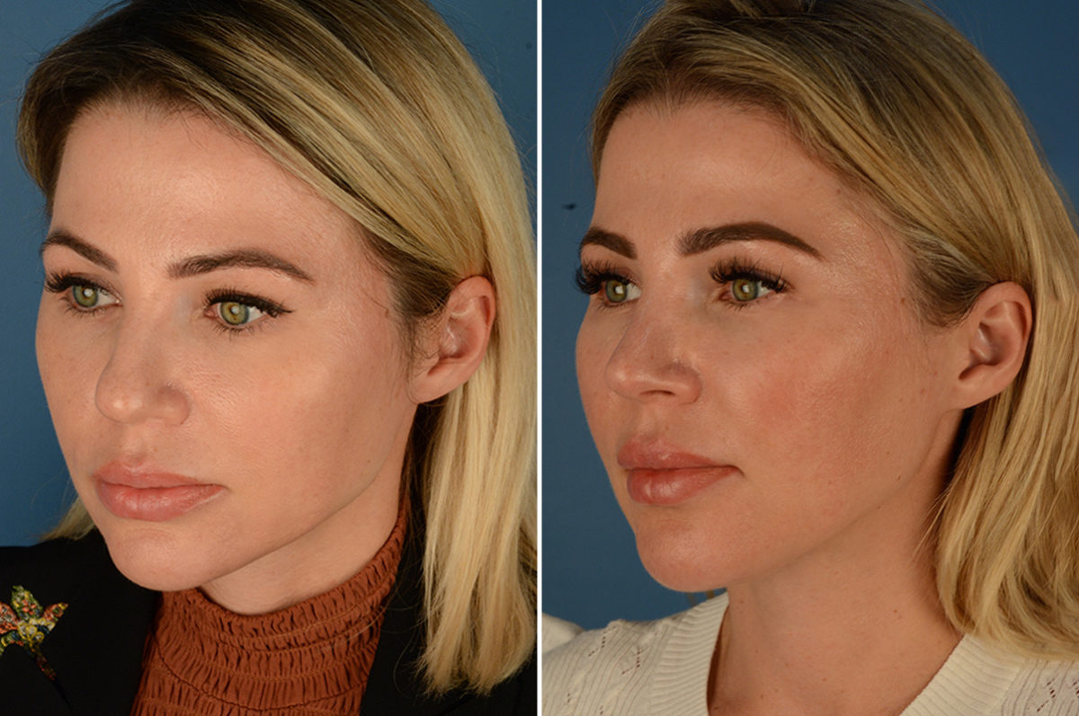 Rhinoplasty Before and After Photos in Naples, FL, Patient 23034