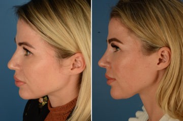 Rhinoplasty Before and After Photos in Naples, FL, Patient 23034