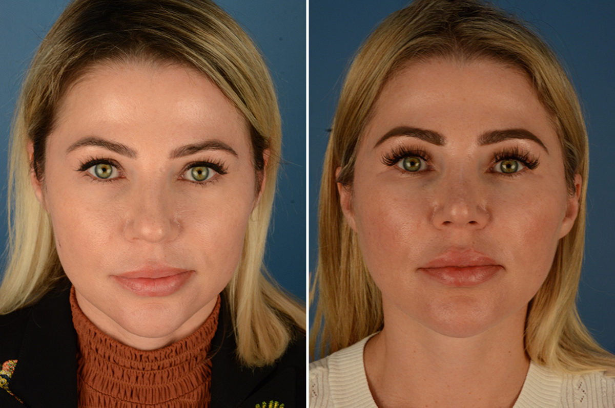 Rhinoplasty Before and After Photos in Naples, FL, Patient 23034