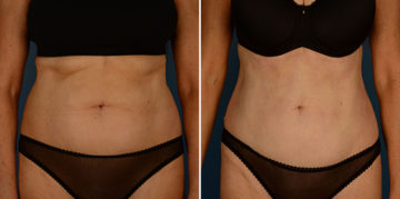 VASER® Liposuction Before and After Photos in Naples, FL, Patient 23050