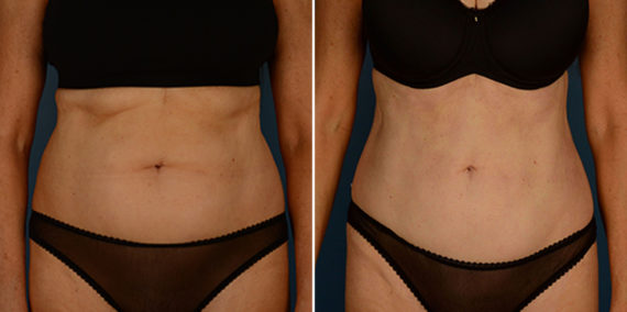 VASER® Liposuction Before and After Photos in Naples, FL, Patient 23050