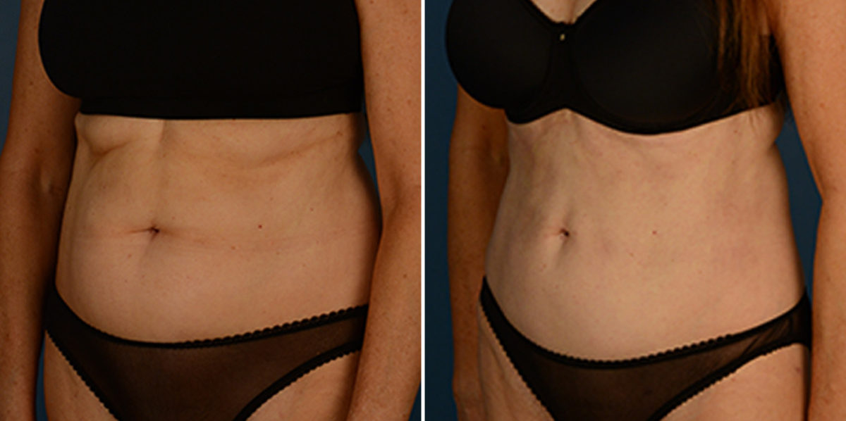 VASER® Liposuction Before and After Photos in Naples, FL, Patient 23050