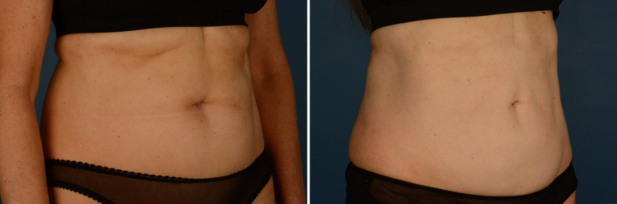 VASER® Liposuction Before and After Photos in Naples, FL, Patient 23050