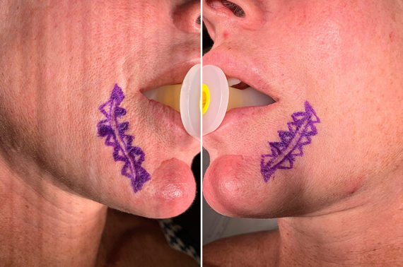 Scar Revision Before and After Photos in Naples, FL, Patient 23055