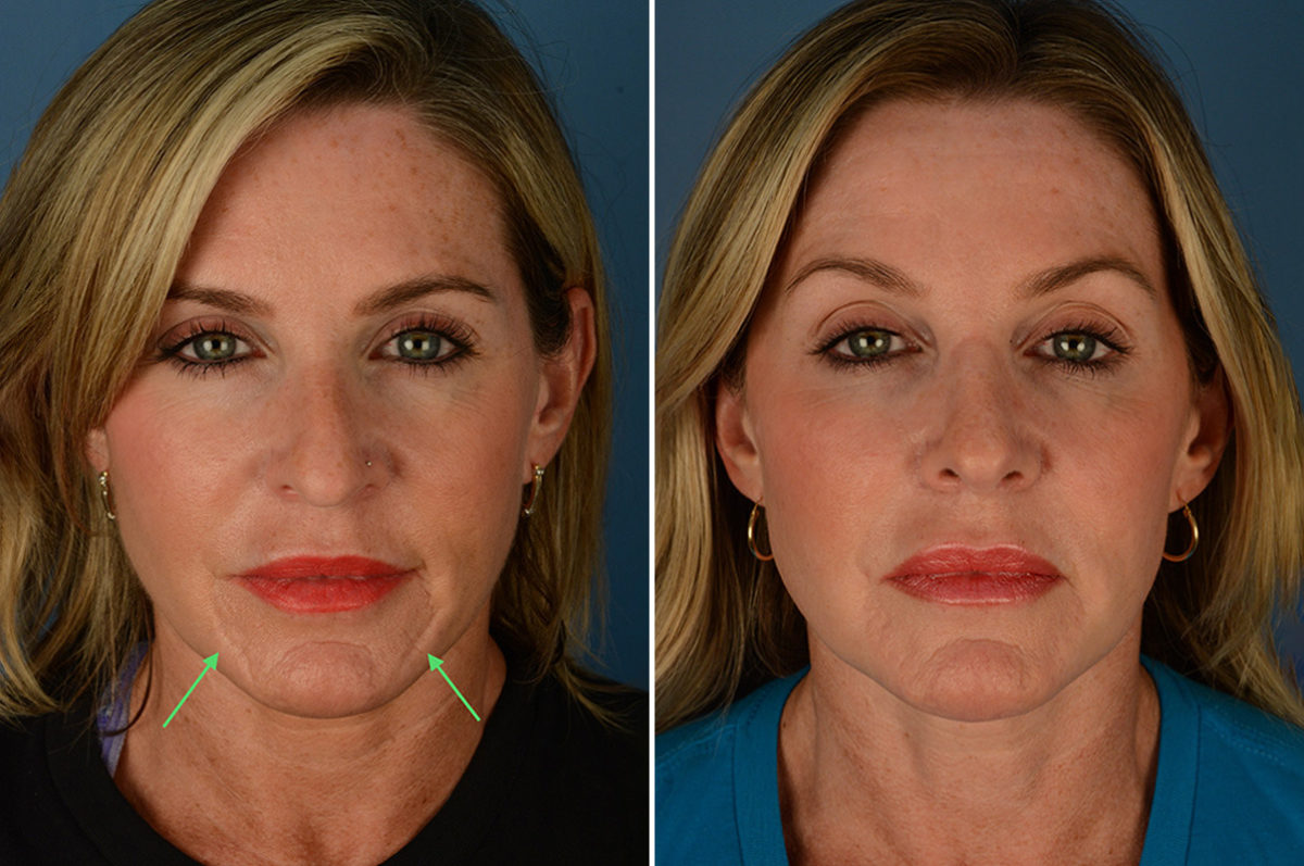 Scar Revision Before and After Photos in Naples, FL, Patient 23055