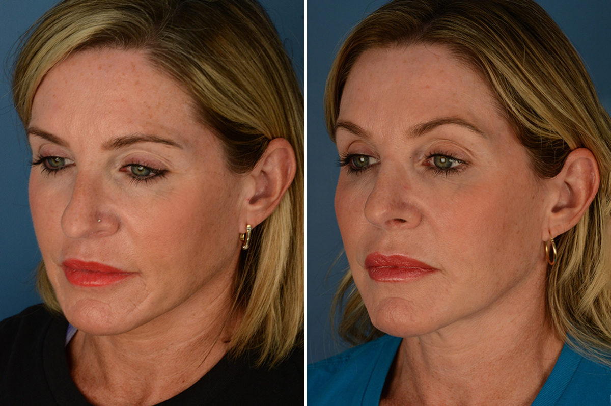 Scar Revision Before and After Photos in Naples, FL, Patient 23055