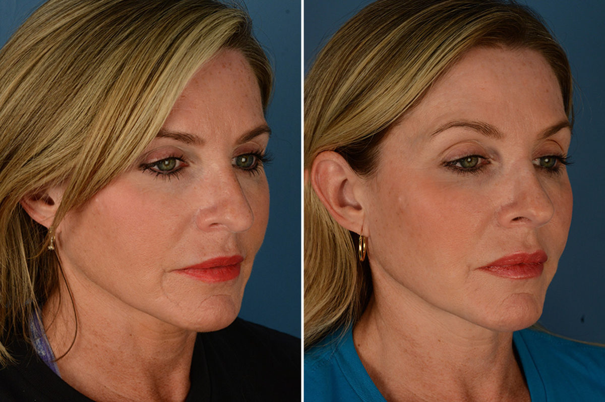 Scar Revision Before and After Photos in Naples, FL, Patient 23055