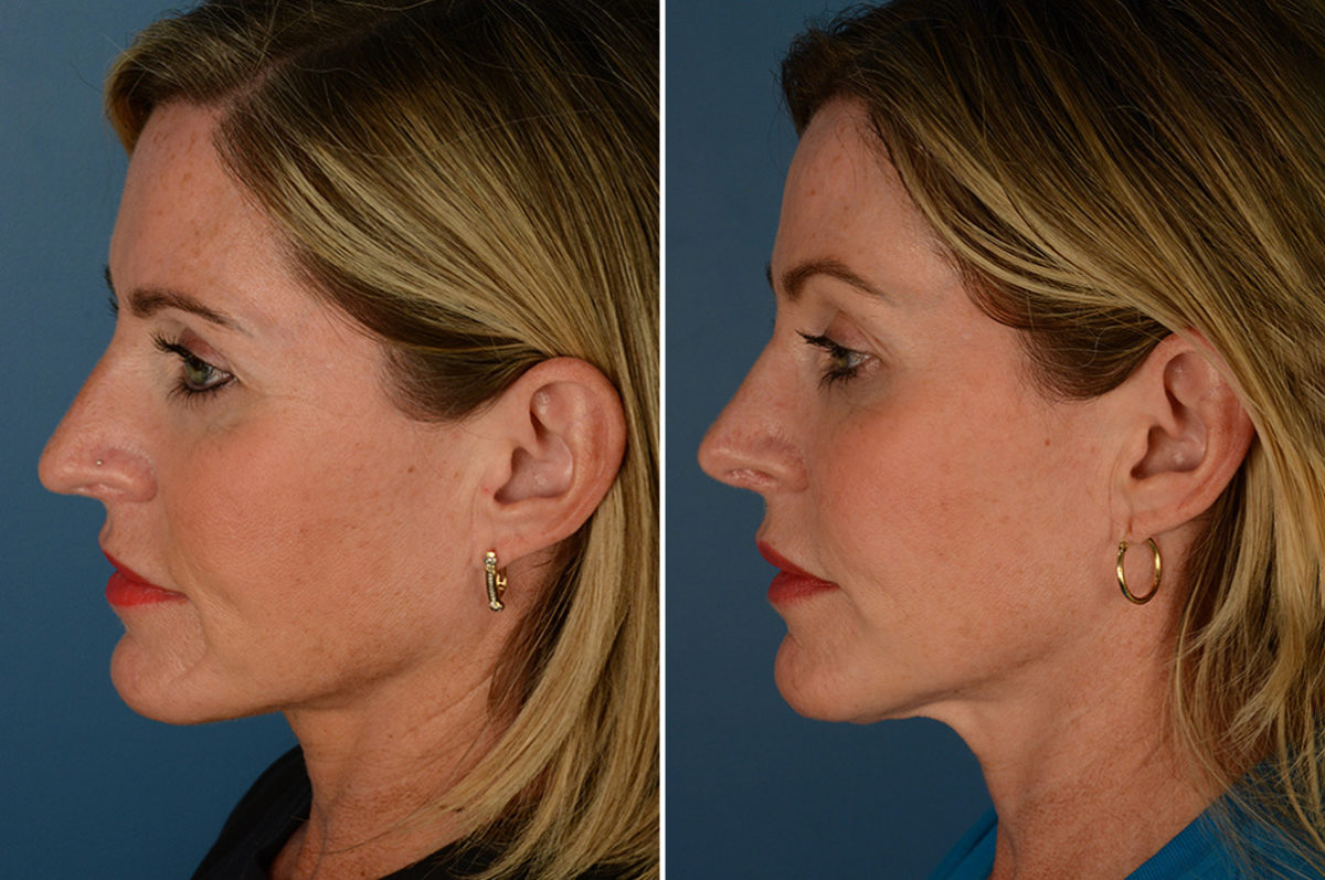 Scar Revision Before and After Photos in Naples, FL, Patient 23055