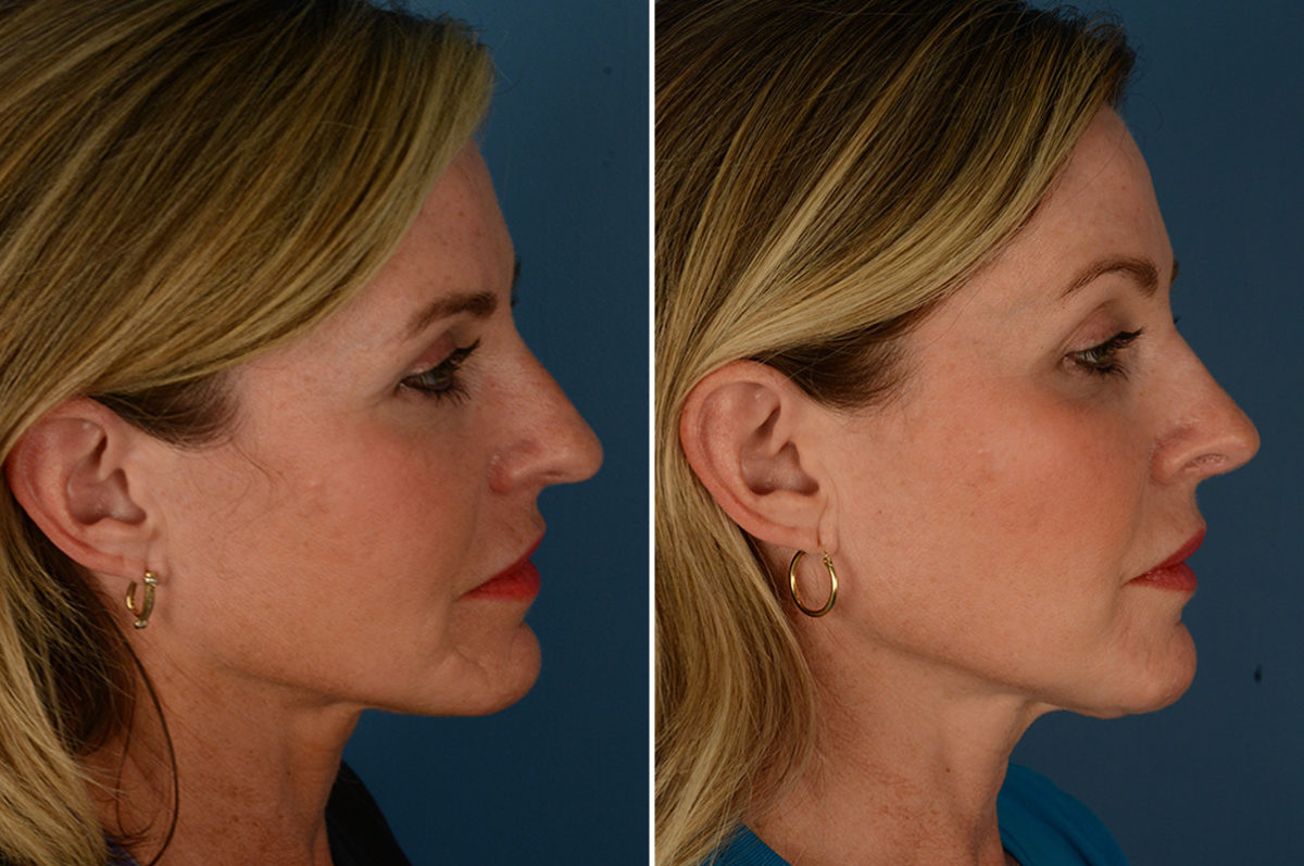 Scar Revision Before and After Photos in Naples, FL, Patient 23055