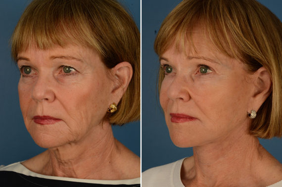 The UpLift™ Lower Face and Neck Lift Before and After Photos in Naples, FL, Patient 23075