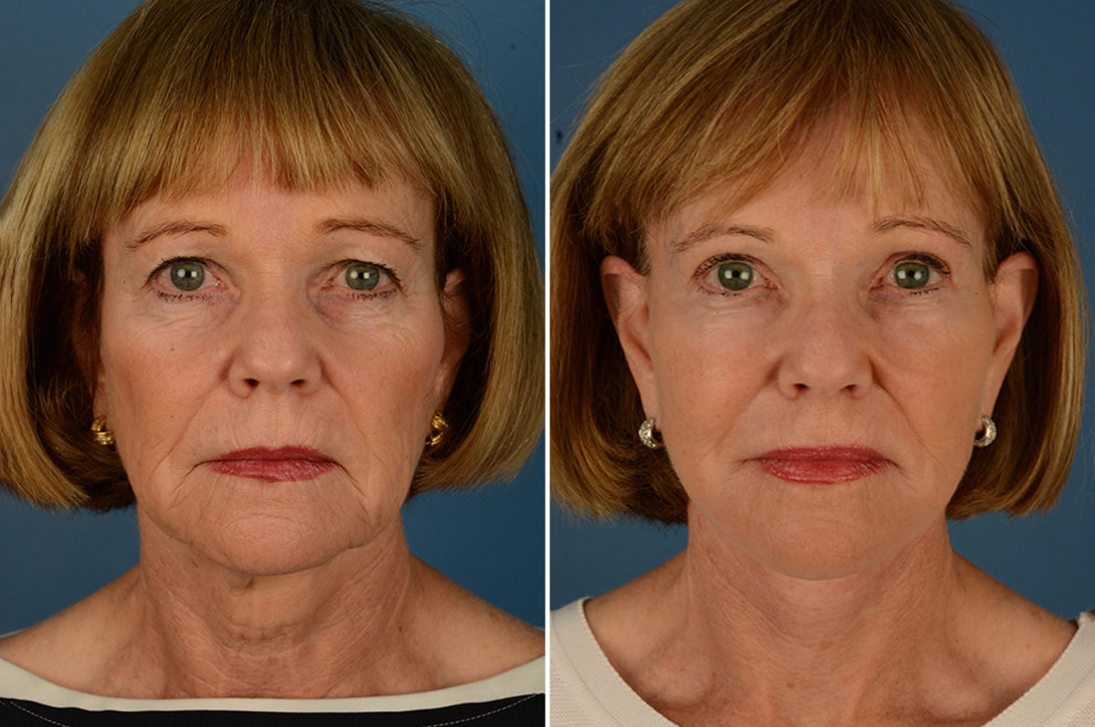 The UpLift™ Lower Face and Neck Lift Before and After Photos in Naples, FL, Patient 23075