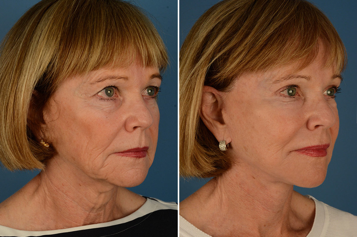 The UpLift™ Lower Face and Neck Lift Before and After Photos in Naples, FL, Patient 23075