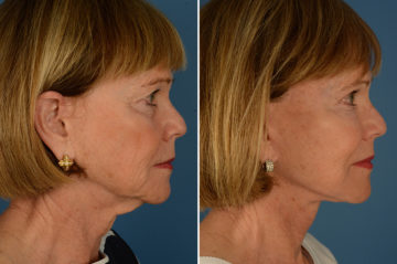 The UpLift™ Lower Face and Neck Lift Before and After Photos in Naples, FL, Patient 23075