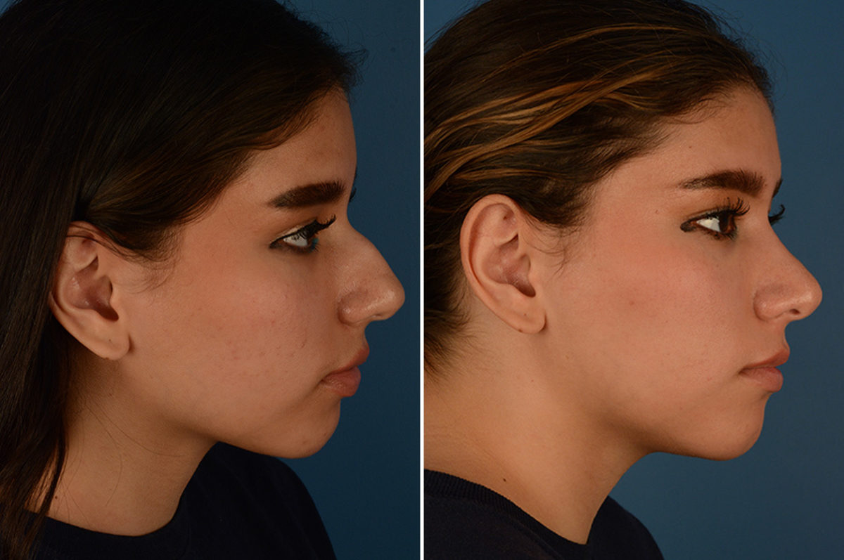 Rhinoplasty Before and After Photos in Naples, FL, Patient 23088