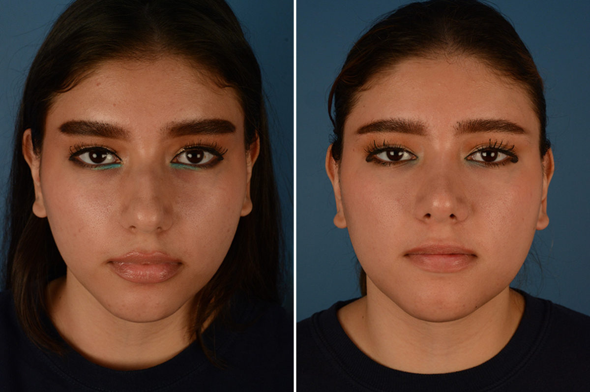 Rhinoplasty Before and After Photos in Naples, FL, Patient 23088