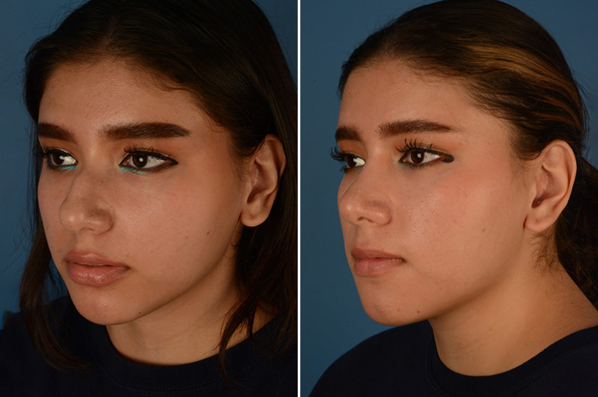 Rhinoplasty Before and After Photos in Naples, FL, Patient 23088