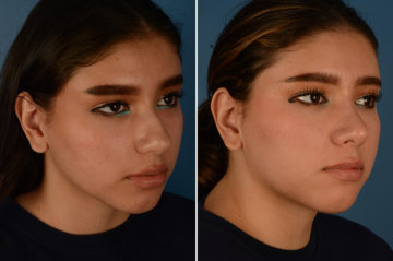 Rhinoplasty Before and After Photos in Naples, FL, Patient 23088