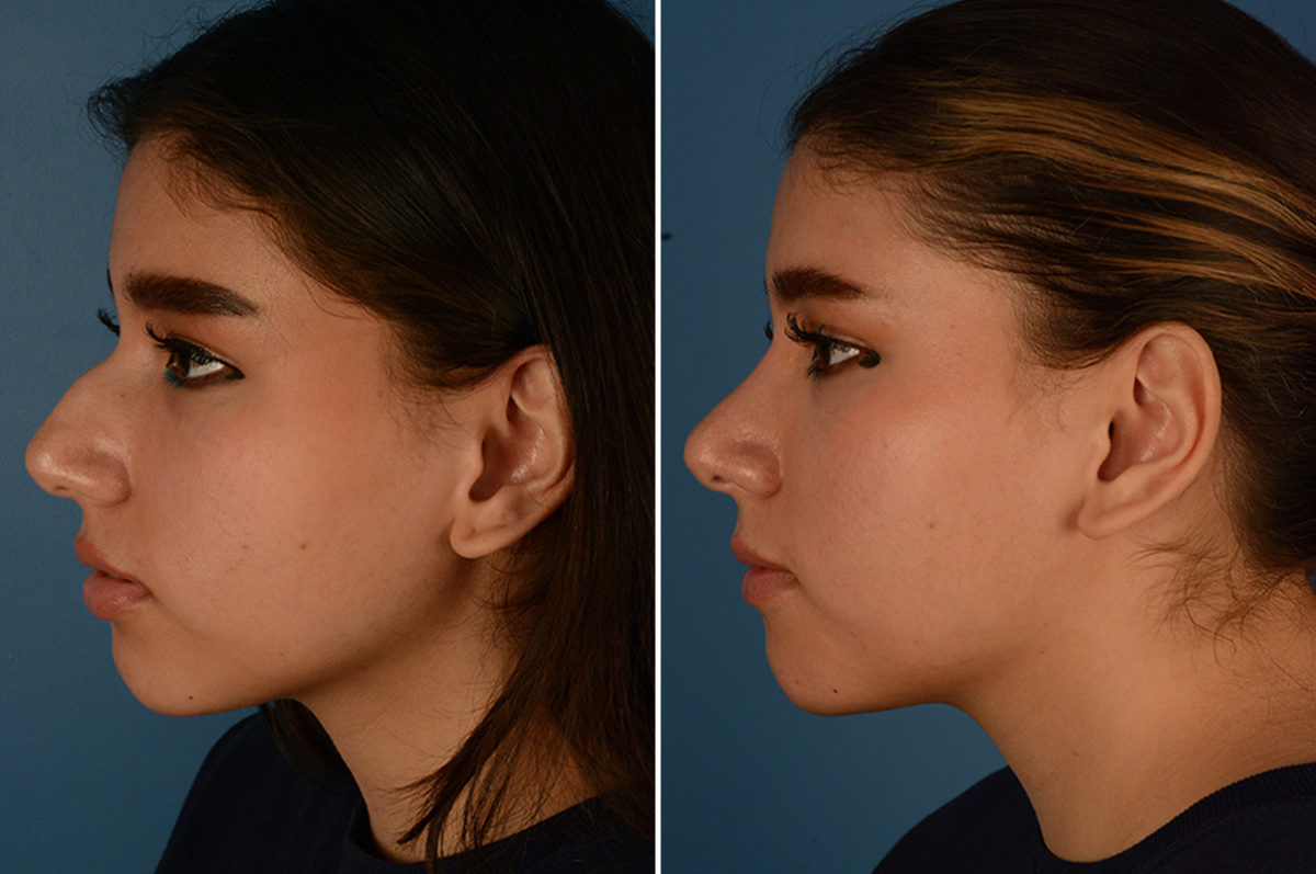 Rhinoplasty Before and After Photos in Naples, FL, Patient 23088