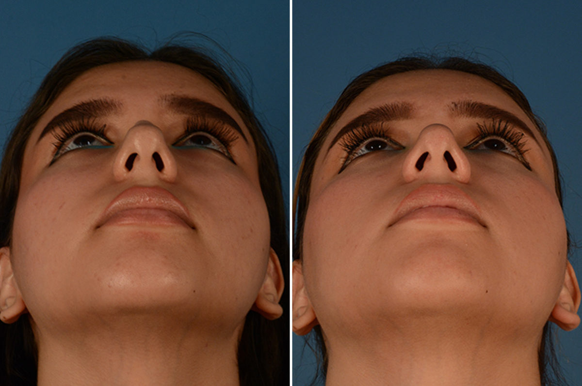 Rhinoplasty Before and After Photos in Naples, FL, Patient 23088