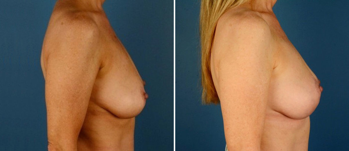 Breast Lift Before and After Photos in Naples, FL, Patient 21087