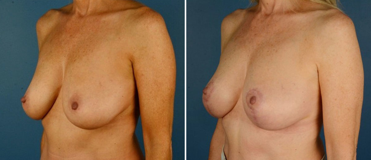 Breast Lift Before and After Photos in Naples, FL, Patient 21087