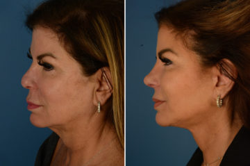 The UpLift™ Lower Face and Neck Lift Before and After Photos in Naples, FL, Patient 23187