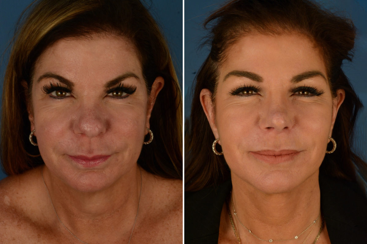 The UpLift™ Lower Face and Neck Lift Before and After Photos in Naples, FL, Patient 23187