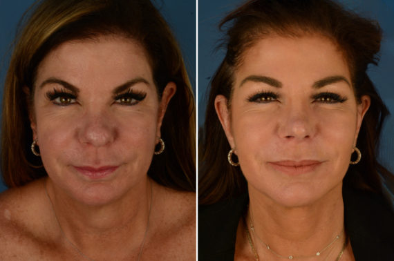 The UpLift™ Lower Face and Neck Lift Before and After Photos in Naples, FL, Patient 23187