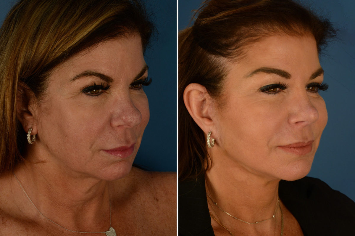 The UpLift™ Lower Face and Neck Lift Before and After Photos in Naples, FL, Patient 23187