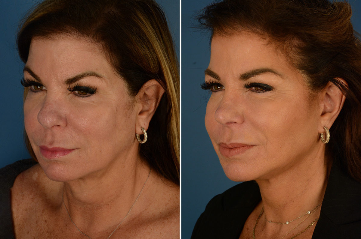 The UpLift™ Lower Face and Neck Lift Before and After Photos in Naples, FL, Patient 23187