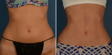 VASER® Liposuction Before and After Photos in Naples, FL, Patient 23209