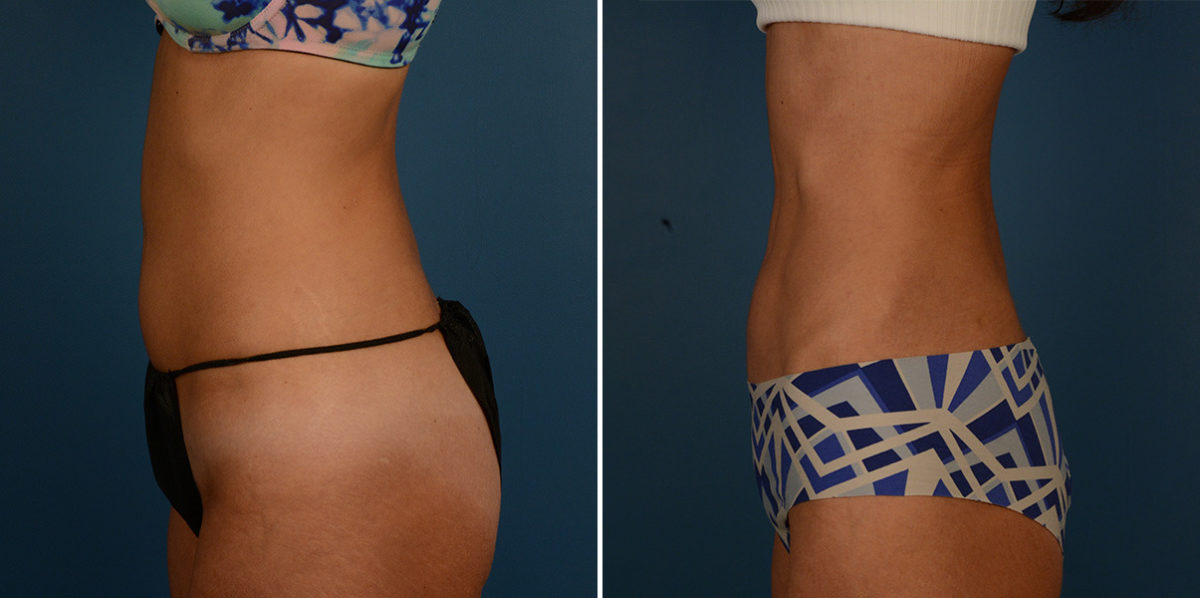 VASER® Liposuction Before and After Photos in Naples, FL, Patient 23209