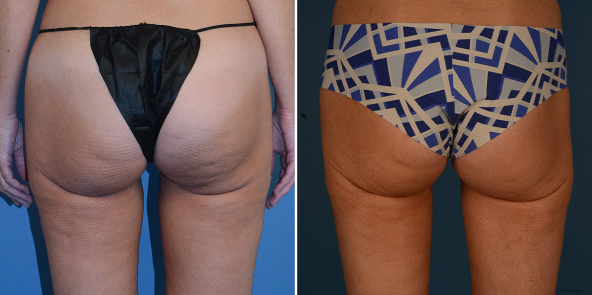 VASER® Liposuction Before and After Photos in Naples, FL, Patient 23209