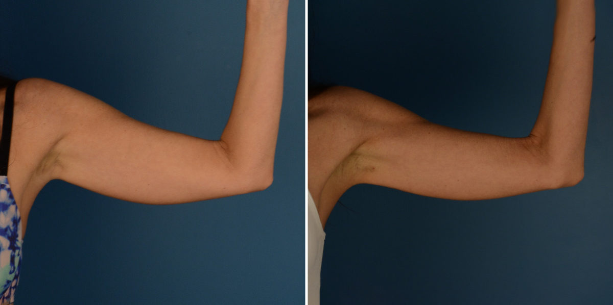 VASER® Liposuction Before and After Photos in Naples, FL, Patient 23216