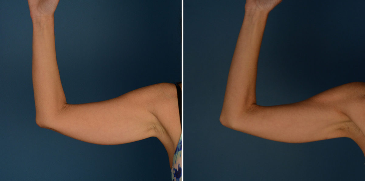 VASER® Liposuction Before and After Photos in Naples, FL, Patient 23216