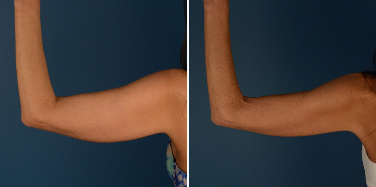 VASER® Liposuction Before and After Photos in Naples, FL, Patient 23216
