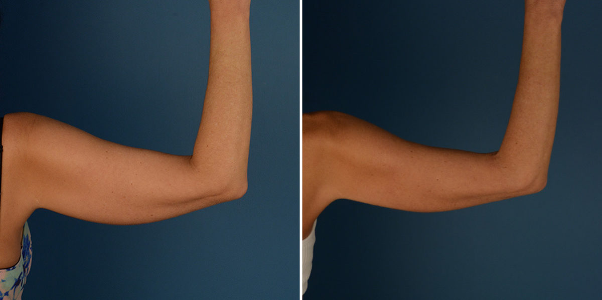 VASER® Liposuction Before and After Photos in Naples, FL, Patient 23216