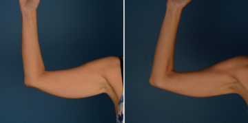 VASER® Liposuction Before and After Photos in Naples, FL, Patient 23216