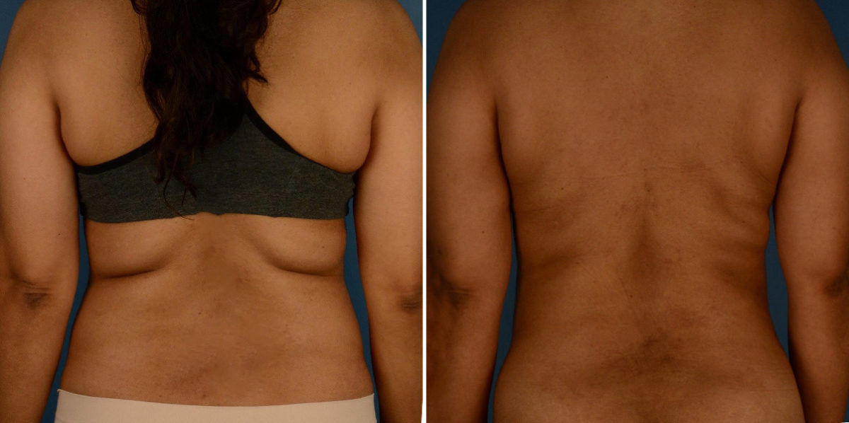 VASER® Liposuction Before and After Photos in Naples, FL, Patient 23241